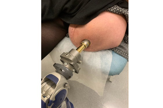 GOE Osteointegracion - Casos de éxito